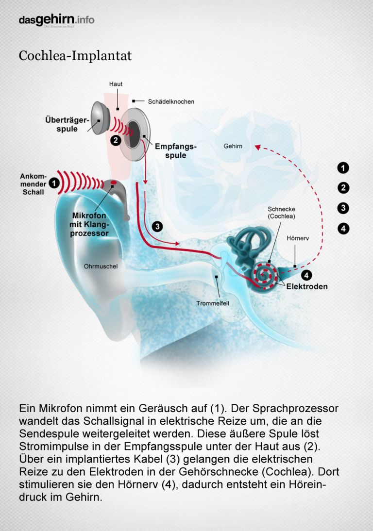 Informationsverarbeitung im Cholea-Implantat