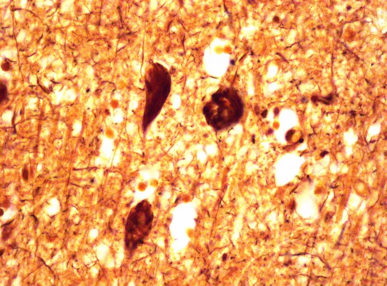 Bielschowsky-Färbung von Neurofibrillen